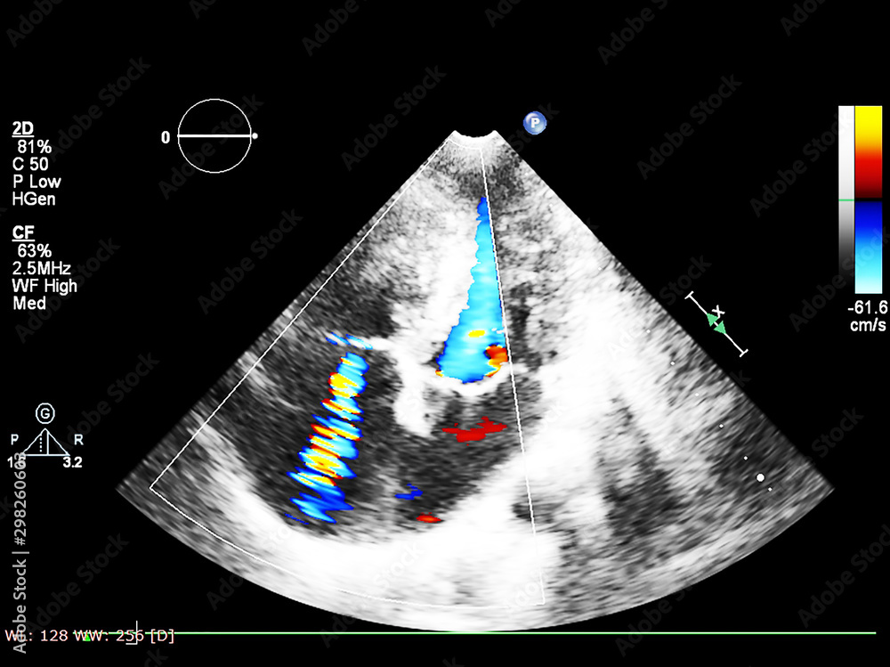 Screen of echocardiography (ultrasound) machine. Stock Photo | Adobe Stock