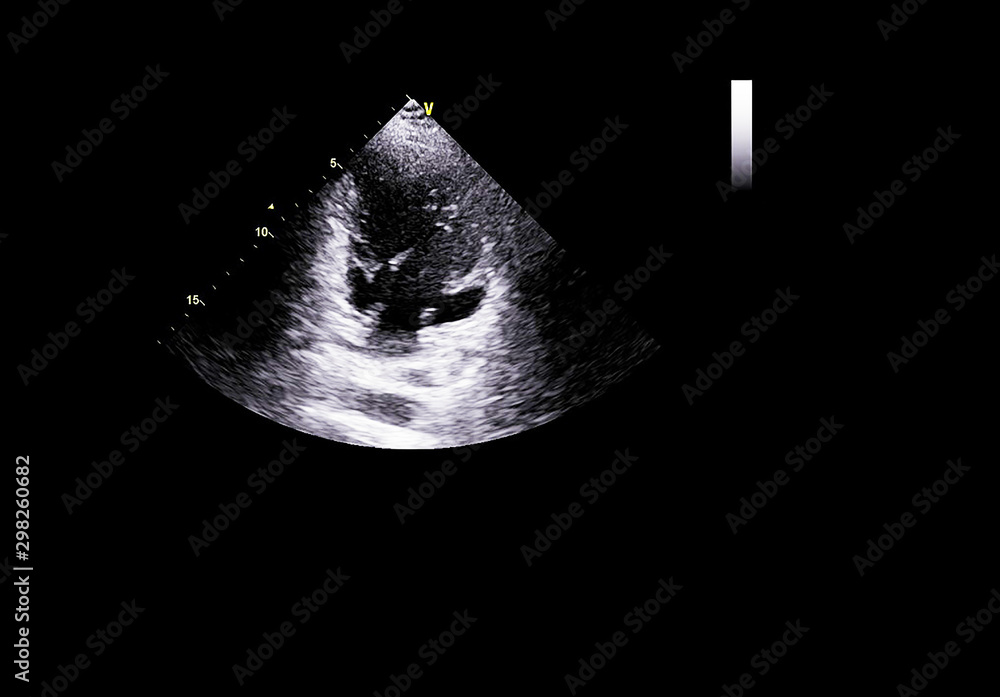Fototapeta premium Screen of echocardiography (ultrasound) machine.