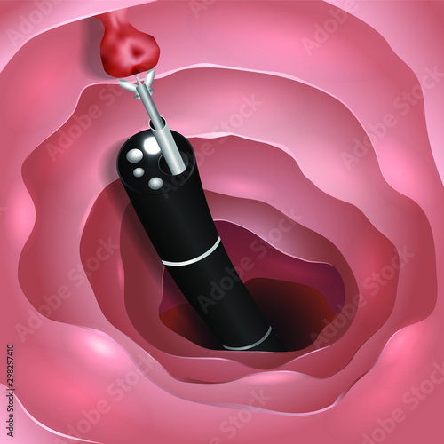 Taking tissue from cancer cell by colonoscopy
