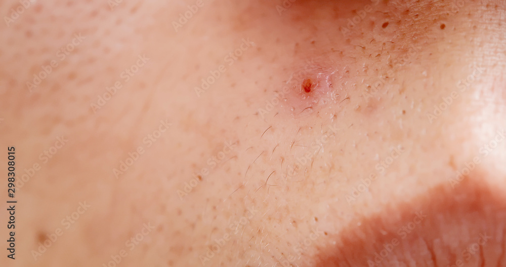 Fototapeta premium acne on the woman face