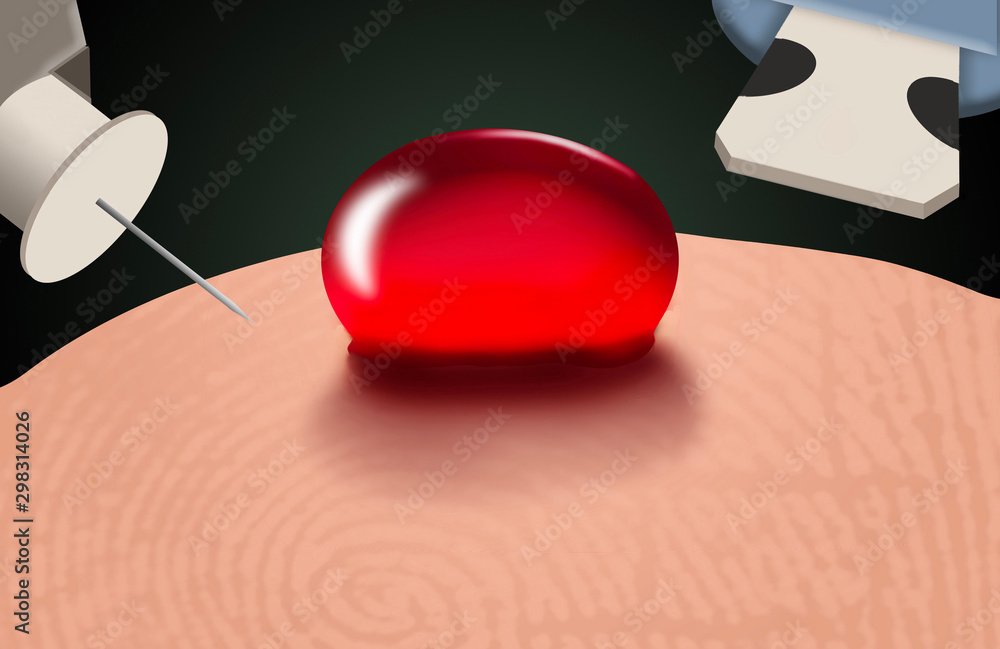Glucose testing for monitoring diabetes is illustrated here with a lance, drop of blood and the tip of a glucose meter.. Glucose testing for monitoring diabetes is illustrated here with a lance, drop of blood and the tip of a glucose meter..
