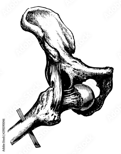 Thyroid Dislocation of the Hip, vintage illustration.