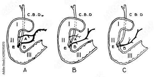 Variations in Termination of the Pancreatic and Bile Ducts, vintage illustration.
