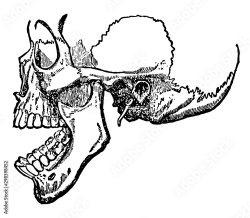 Dislocation of the Lower Jaw, vintage illustration.
