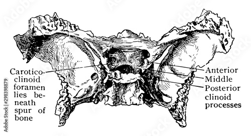 Abnormal Sphenoid Bone, vintage illustration.