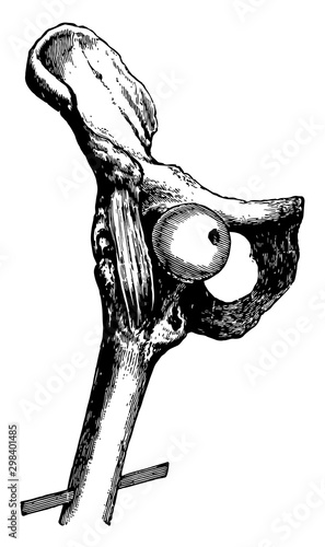 Hip Dislocation upon the Pubes, vintage illustration.