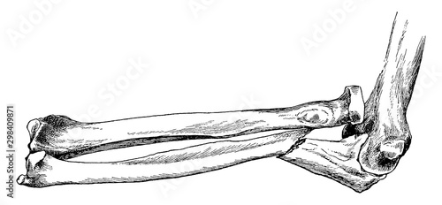 Fractured Ulna with Dislocation of Radius, vintage illustration.