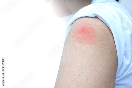 Skin rash and swelling on old woman arm cause by rabies vaccine on white background,immunizations prevent infectious disease in human, medical concept,selective focus