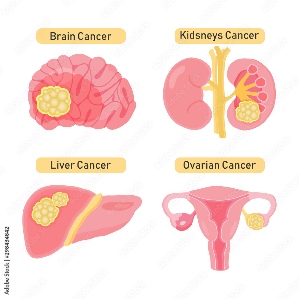Stomach cancer diagram .Vector illustration in flat style.