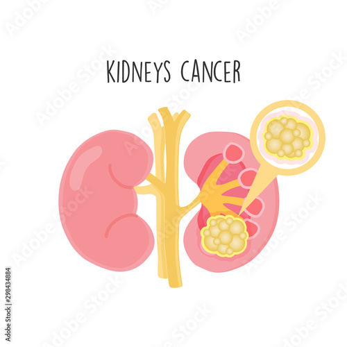 Kidney Cancer flat vector illustration.
