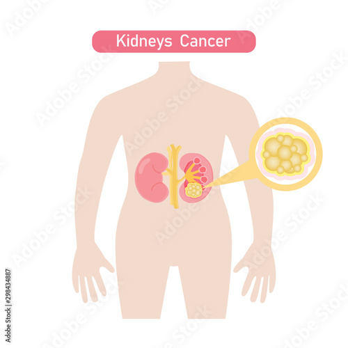 Kidney cancer diagram .Vector illustration in flat style.