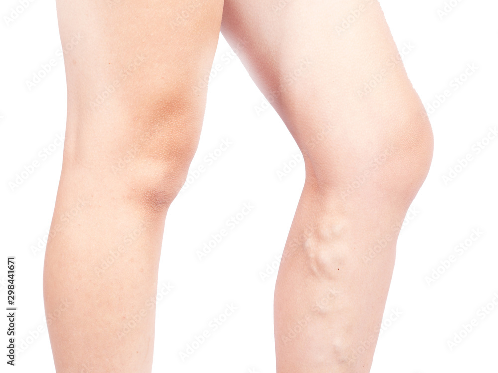 Female Legs in Compression Stockings for Varicose Veins on the Legs. White  Background Stock Image - Image of pregnant, puffiness: 293926999