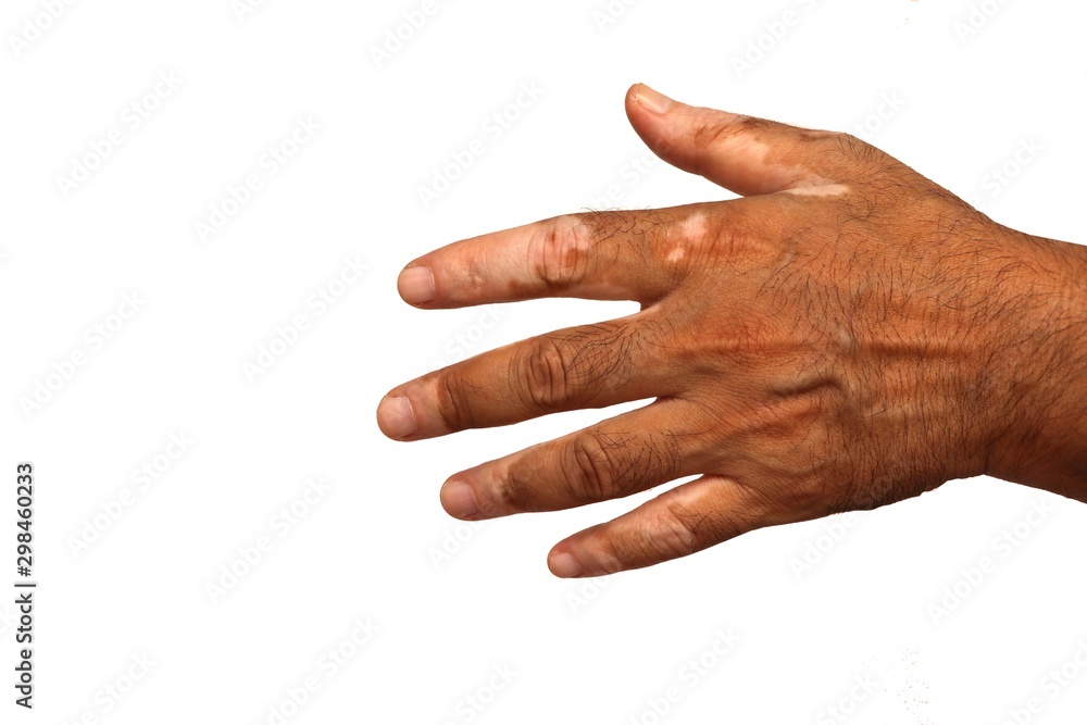 Vitilo on spreading hand on white isolated background Vitilo on spreading hand on white isolated background