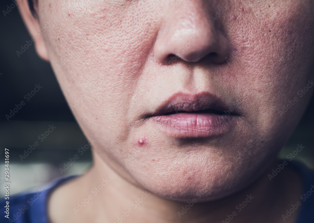 Obraz premium acne skin