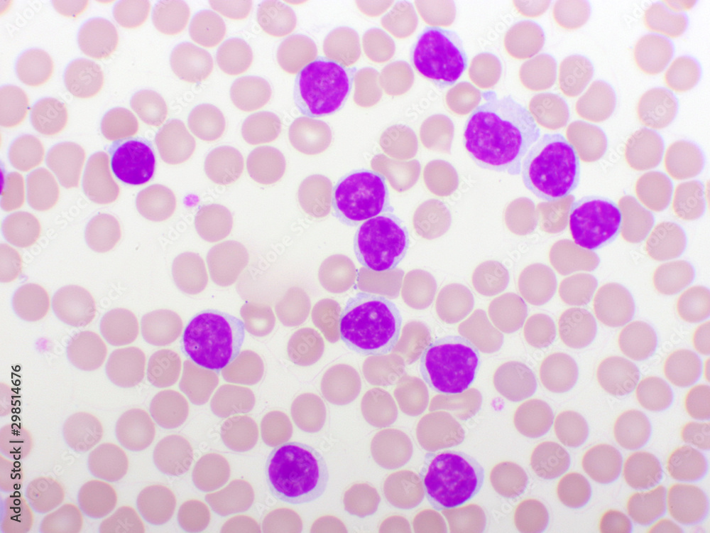 Blood picture of chronic lymphocytic leukemia or CLL, analyze by microscope, original magnification 1000x Blood picture of chronic lymphocytic leukemia or CLL, analyze by microscope, original magnification 1000x