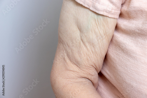 An excess loose skin on an arm of a senior elderly woman after extreme weight loss