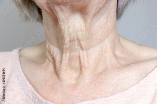 Tela A flabby wrinkled excess skin on the neck of a senior woman close up