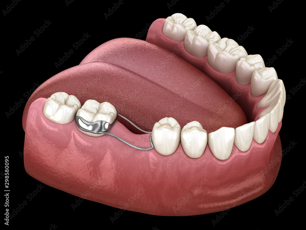 Space Maintainer Unilateral keeps from teeth shift deformatiuon after