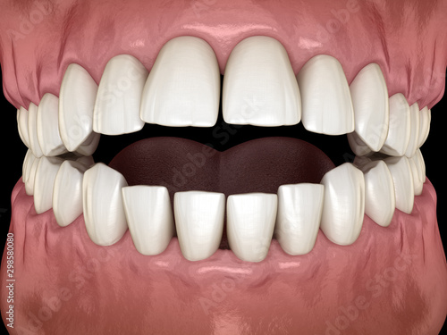 Foto Openbite dental occlusion ( Malocclusion of teeth )