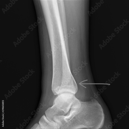 radiography of the ankle joint with a fracture of the outer ankle  traumatology and orthopedics rheumatology