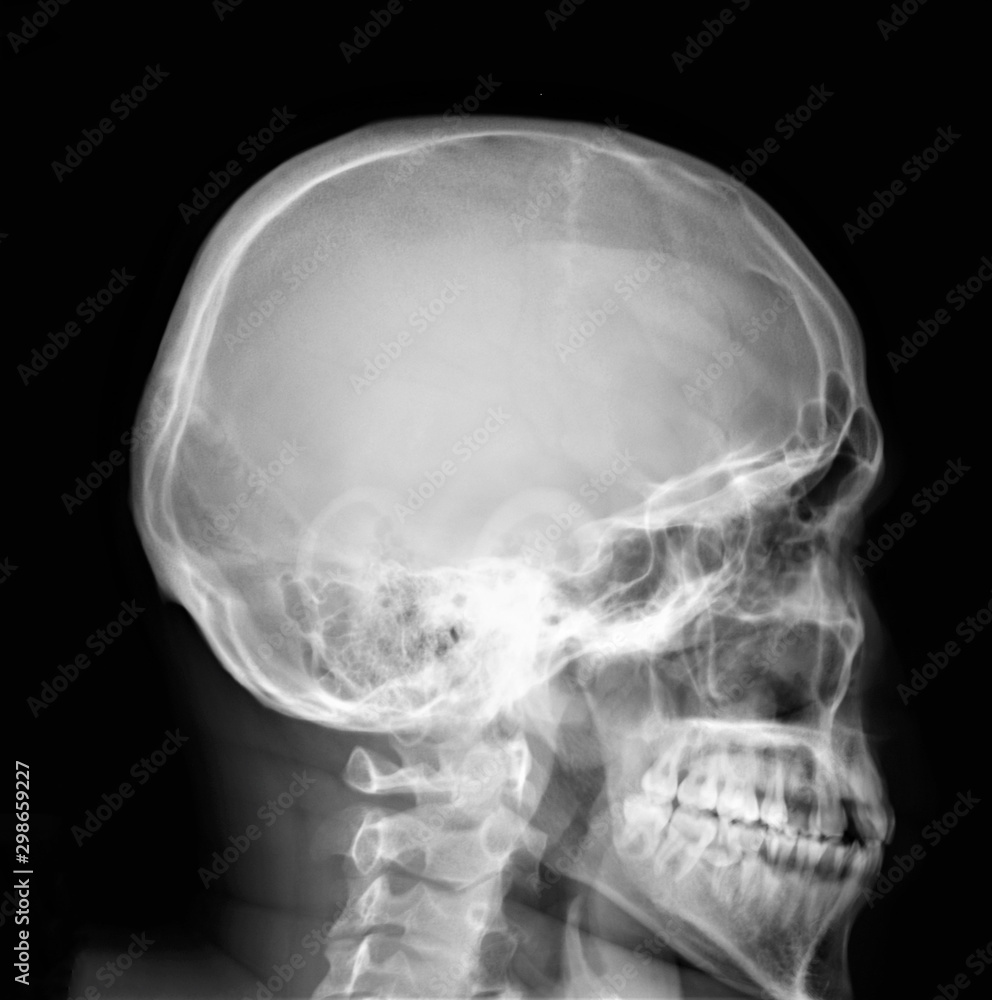 normal x-ray of the skull in lateral projection normal x-ray of the skull in lateral projection