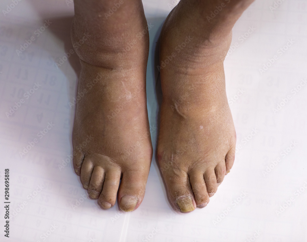 Fototapeta premium swollen legs with fungal infection isolated on white background
