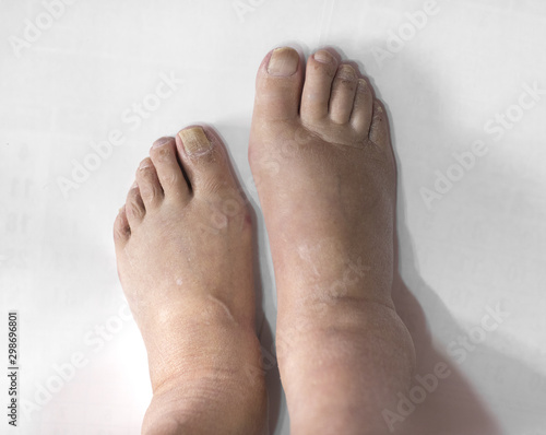 Photo swollen legs with fungal infection isolated on white background