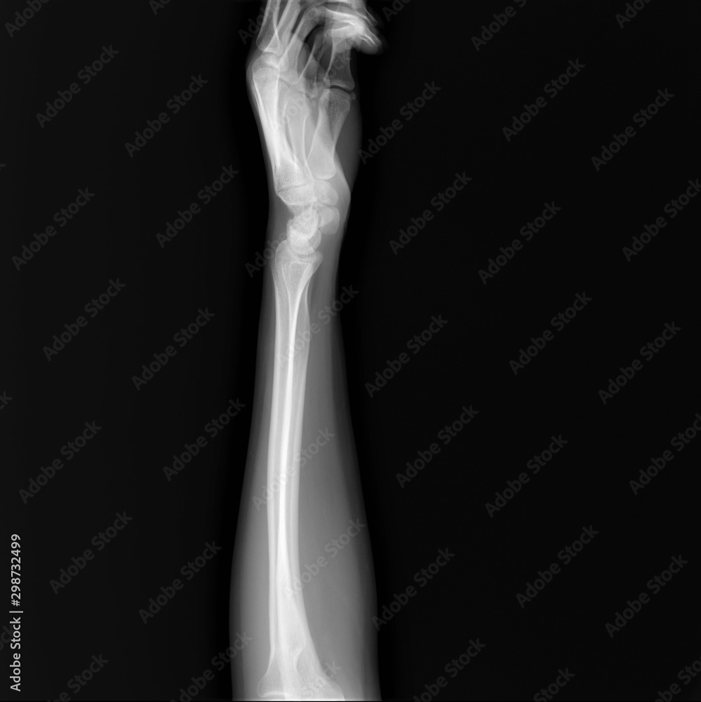 normal radiography of hand and wrist bones, traumatology and orthopedics, traumatology, sports injury normal radiography of hand and wrist bones, traumatology and orthopedics, traumatology, sports injury