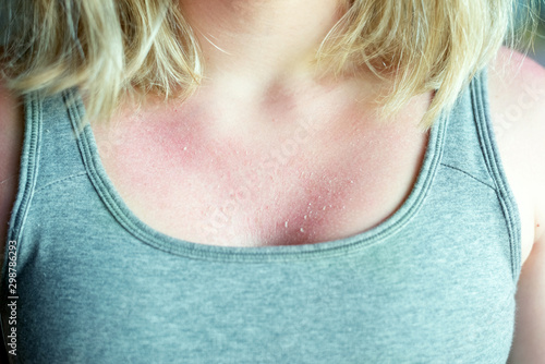 Принти на полотні The flaky skin from a bad tan on the girl’s chest causes severe itching