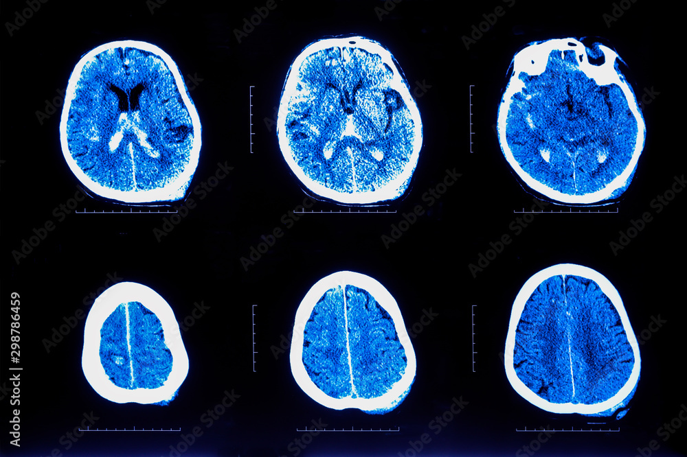 MRI of the brain.Xray film of the brain computed tomography. Stock