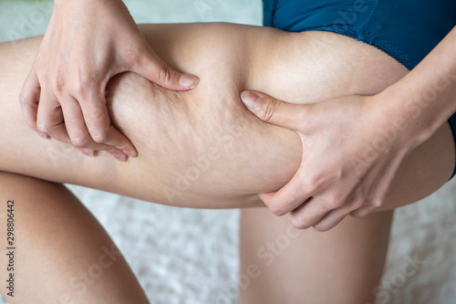 Photos fat woman, fat girl, fat leg with cellulite; hand of woman holding excessive thi