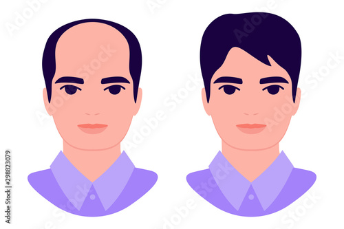 Man baldness problem. Male with alopecia before and after. Hair loss. Hair treatment, transplantation, health and beauty concept. Isolated vector illustration on white background