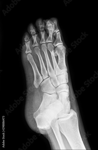 Foot x-ray image for use in treating patients. Patients with foot-related symptoms.