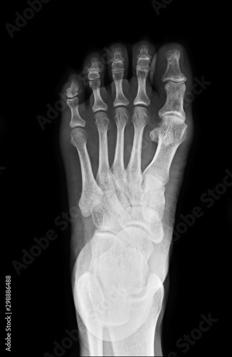 Foot x-ray image for use in treating patients. Patients with foot-related symptoms. © Tushchakorn