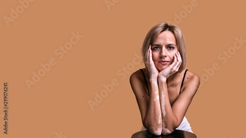 Girl with vitiligo disease covers her face with hands, closeup portrait on beige background