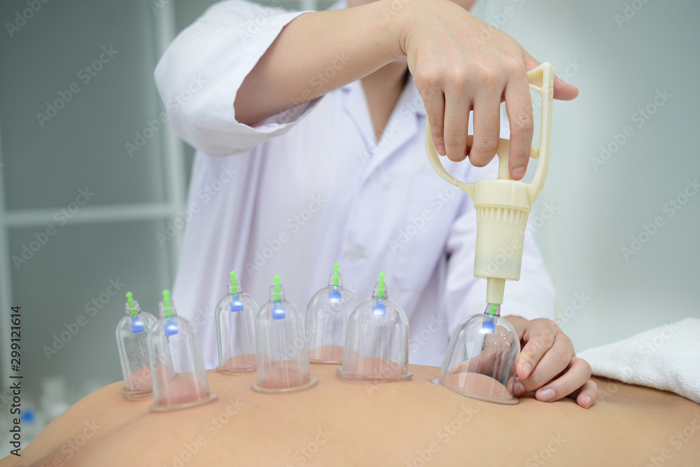 Doctor preparing cups to place on the patient’s back for cupping treatment,traditional chinese medicine treatment. Doctor preparing cups to place on the patient’s back for cupping treatment,traditional chinese medicine treatment.