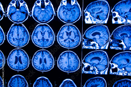Computerized x-ray image of the patient's body for treatment.research in medicine. CT scan of the patient.
