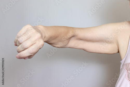 An excess loose skin on an arm of a senior elderly woman after extreme weight loss photo