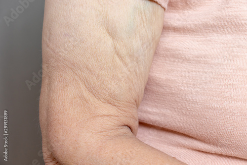 Billede på lærred An excess loose skin on an arm of a senior elderly woman after extreme weight lo