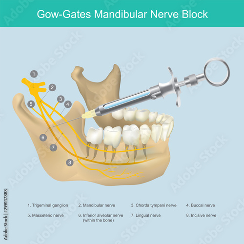Mandibular Nerve Block. Illustration reference to Dentist the lower jaw area aesthetic just injection, to stop the pain from teeth nerves. photo