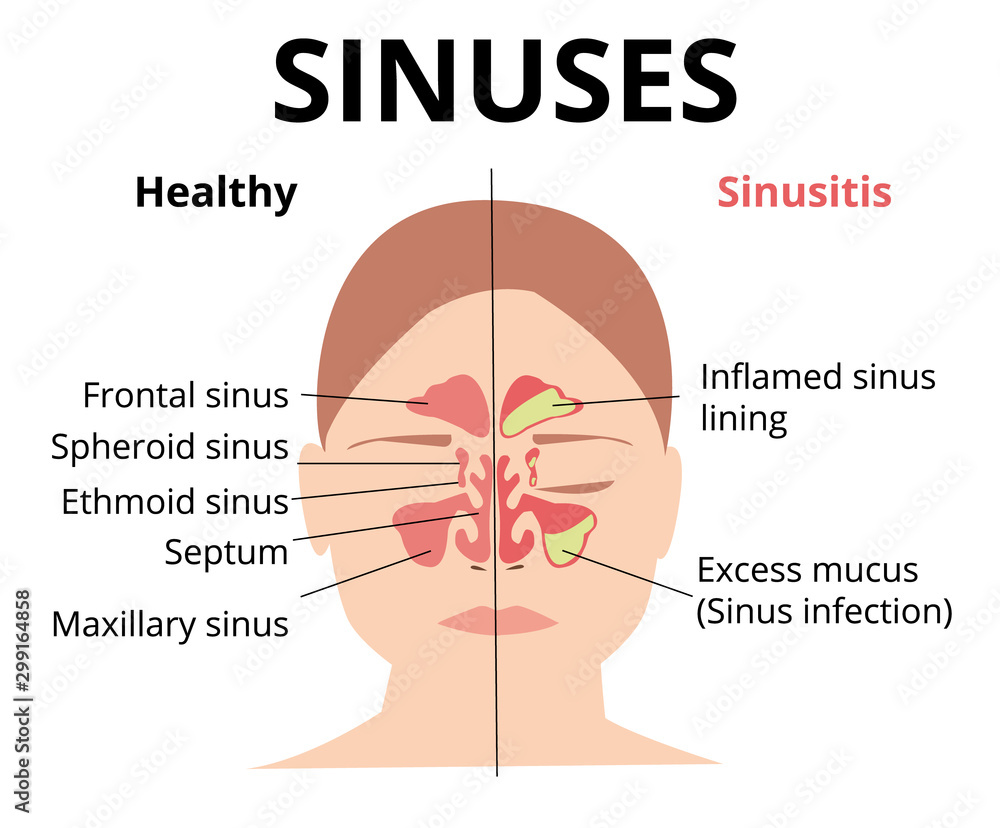 Sinusitis medical treatment. Nasal sinus. Healthy and inflammation