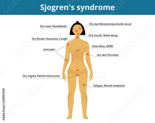 Sjogren's syndrome symptoms. Dry syndrome signs and symptoms