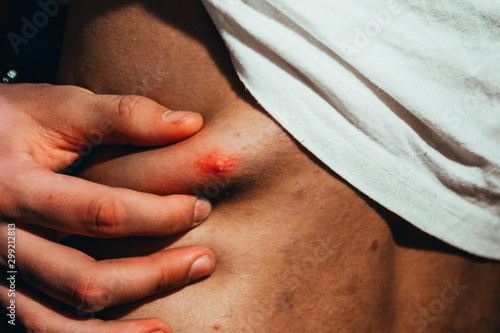 Fotografie Big red pimple on a man's back