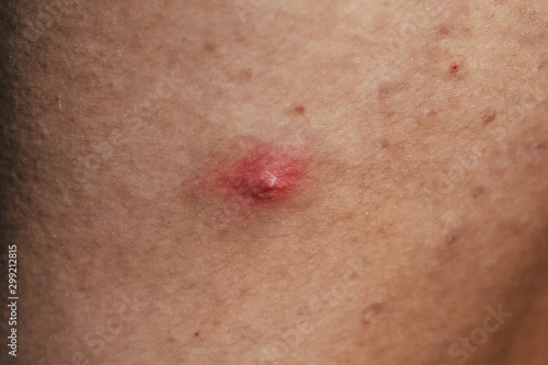 Schilderij op canvas Big red pimple on a man's back