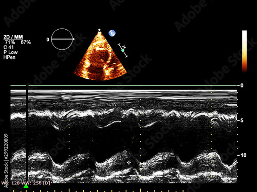 Screen of echocardiography (ultrasound) machine.