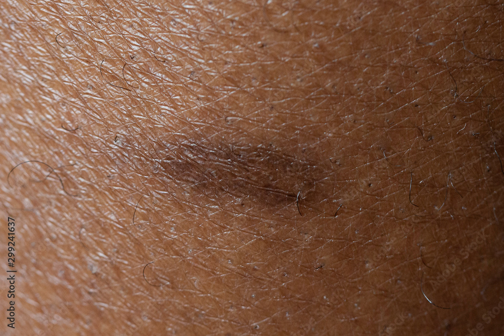 Fototapeta premium Macro view of birthmark on human skin