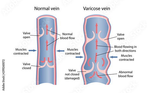 Dynamics of venous circulation with varicose veins. Longitudinal section of vein with description of the main parts. Vector illustration. photo