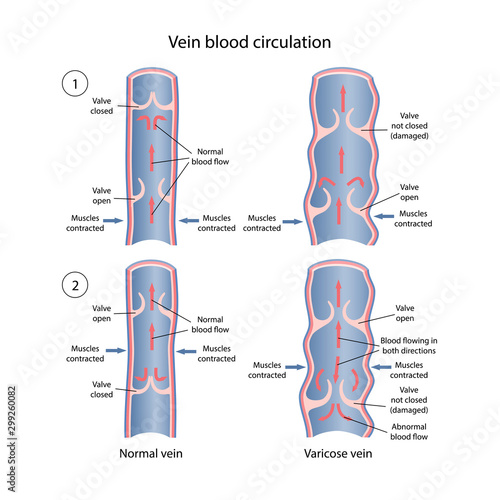 Comparative diagram of venous circulation with normal and varicose veins. A longitudinal section of a vein with a description of the main parts. Vector illustration