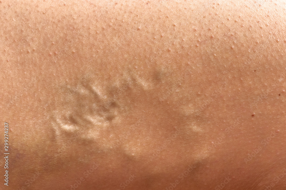 varicose veins on the skin. Macro shot. Madical and cosmetic problem. Close up