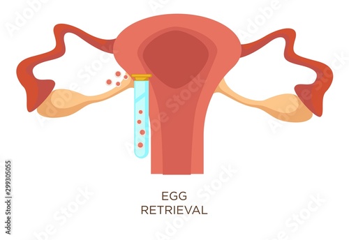 Egg retrieval stage in vitro fertilization artificial insemination